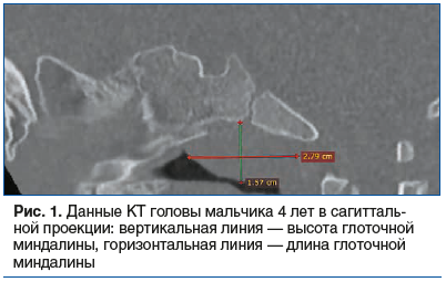 Назальная обструкция в детском и юношеском возрасте с анатомической позиции